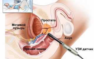 Трансректальное УЗИ
